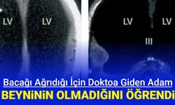 Bacağı ağrıdığı için doktora gitti: Beyninin olmadığını öğrendi